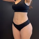 Liposuction Before & After Patient #15988