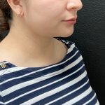 Jawline/Neck Before & After Patient #15907
