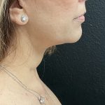 Jawline/Neck Before & After Patient #15989