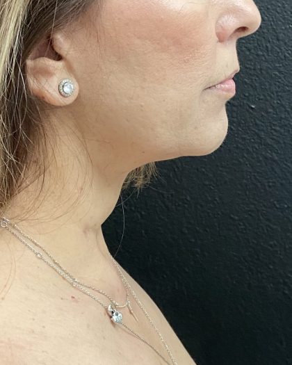 Jawline/Neck Before & After Patient #15989