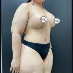 Mommy Makeover Before & After Patient #15909