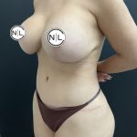 Mommy Makeover Before & After Patient #15990