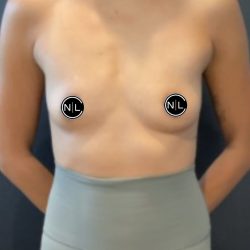 Breast Augmentation Before & After Patient #16027