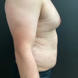 Gynecomastia Before & After Patient #16028