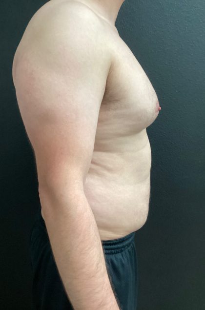 Gynecomastia Before & After Patient #16028