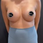 Breast Augmentation Before & After Patient #16027