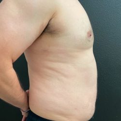 Gynecomastia Before & After Patient #16028