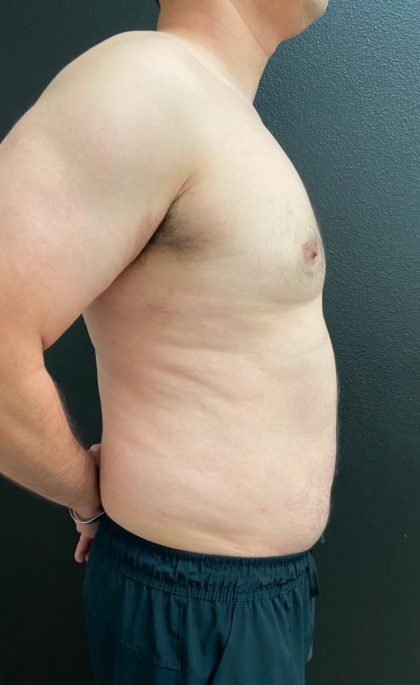 Gynecomastia Before & After Patient #16028