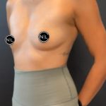 Breast Augmentation Before & After Patient #16027