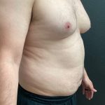 Gynecomastia Before & After Patient #16028
