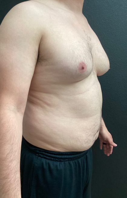 Gynecomastia Before & After Patient #16028