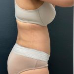 Abdominoplasty Before & After Patient #16029