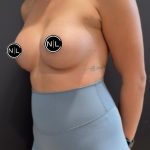 Breast Augmentation Before & After Patient #16027