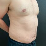 Gynecomastia Before & After Patient #16028