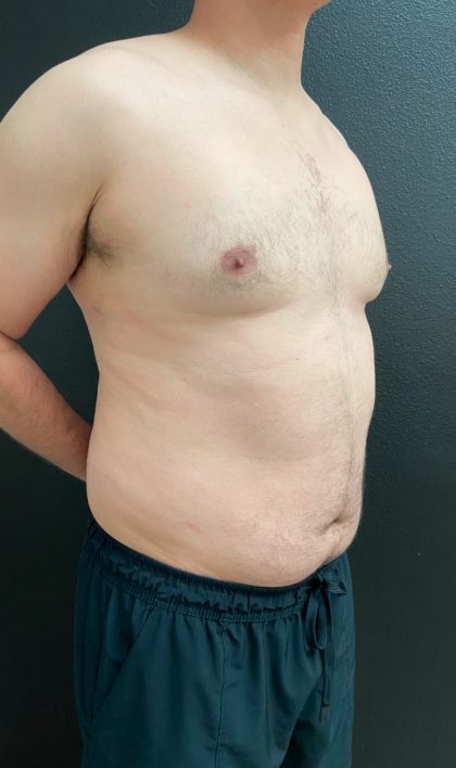 Gynecomastia Before & After Patient #16028