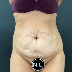 Abdominoplasty Before & After Patient #16065