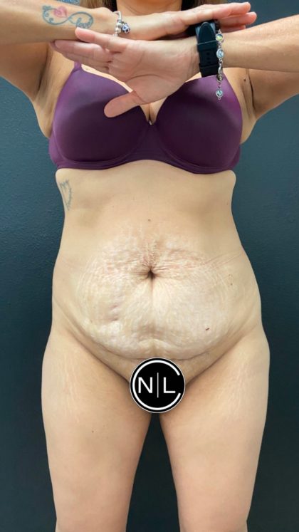 Abdominoplasty Before & After Patient #16065