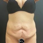 Abdominoplasty Before & After Patient #16066