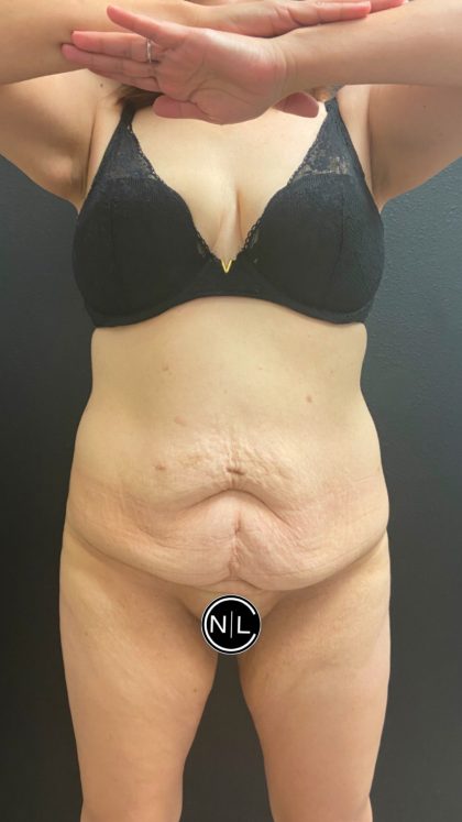 Abdominoplasty Before & After Patient #16066