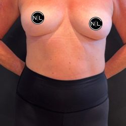 Breast Augmentation Before & After Patient #16069