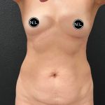 Mommy Makeover Before & After Patient #16067
