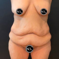 Mommy Makeover Before & After Patient #16068