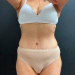 Abdominoplasty Before & After Patient #16065