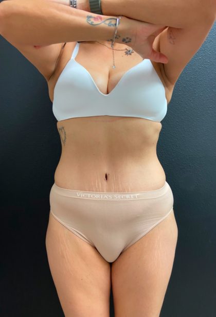 Abdominoplasty Before & After Patient #16065