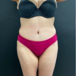 Abdominoplasty Before & After Patient #16066