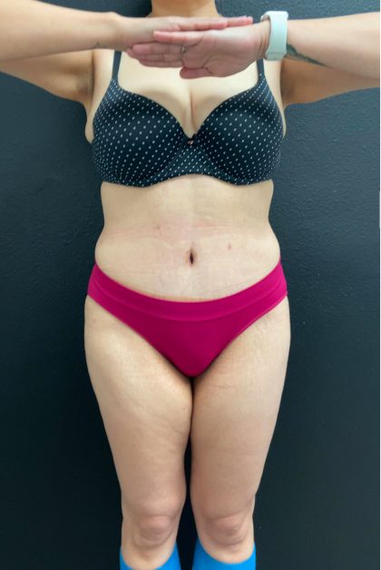 Abdominoplasty Before & After Patient #16066