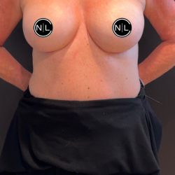 Breast Augmentation Before & After Patient #16069