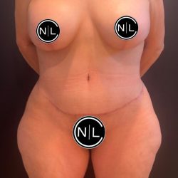 Mommy Makeover Before & After Patient #16068