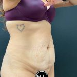 Abdominoplasty Before & After Patient #16065