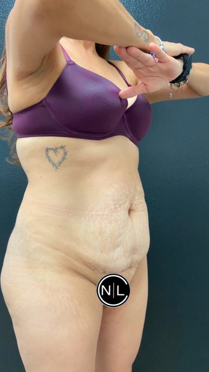 Abdominoplasty Before & After Patient #16065