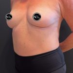 Breast Augmentation Before & After Patient #16069