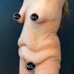 Mommy Makeover Before & After Patient #16068