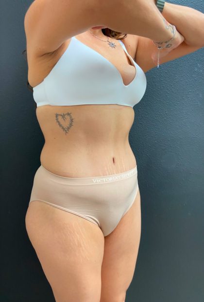 Abdominoplasty Before & After Patient #16065