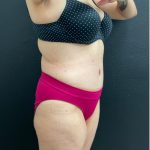 Abdominoplasty Before & After Patient #16066