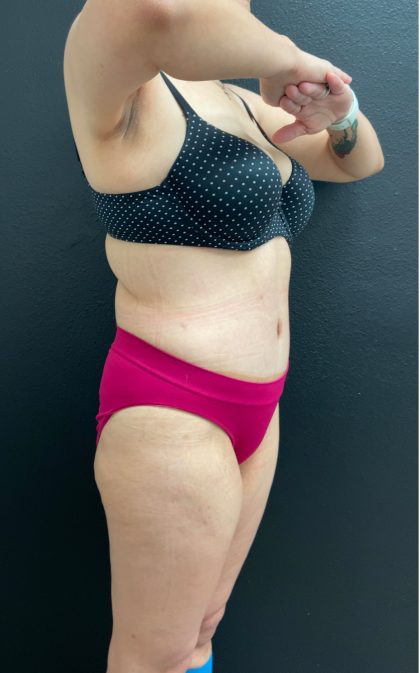 Abdominoplasty Before & After Patient #16066