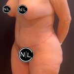 Mommy Makeover Before & After Patient #16068