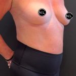 Breast Augmentation Before & After Patient #16069
