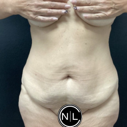 Abdominoplasty Before & After Patient #16103