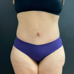 Abdominoplasty Before & After Patient #16103