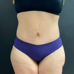 Abdominoplasty Before & After Patient #16103