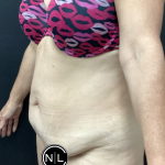 Abdominoplasty Before & After Patient #16103