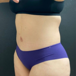 Abdominoplasty Before & After Patient #16103