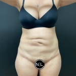 Abdominoplasty Before & After Patient #16153