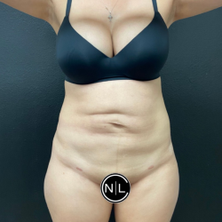 Abdominoplasty Before & After Patient #16153