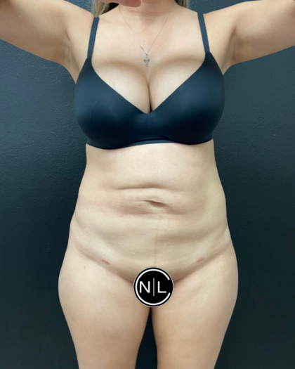 Abdominoplasty Before & After Patient #16153