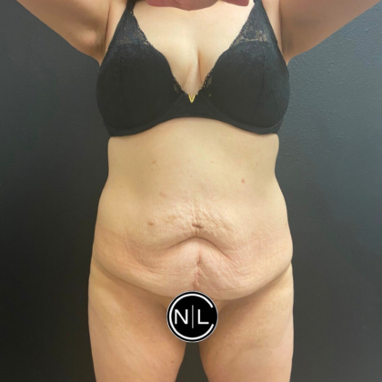 Tummy Tuck Before & After Patient #16260